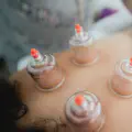 Cupping Therapy for Runners: Does It Really Work?